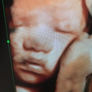 3D Ultrasound Photo